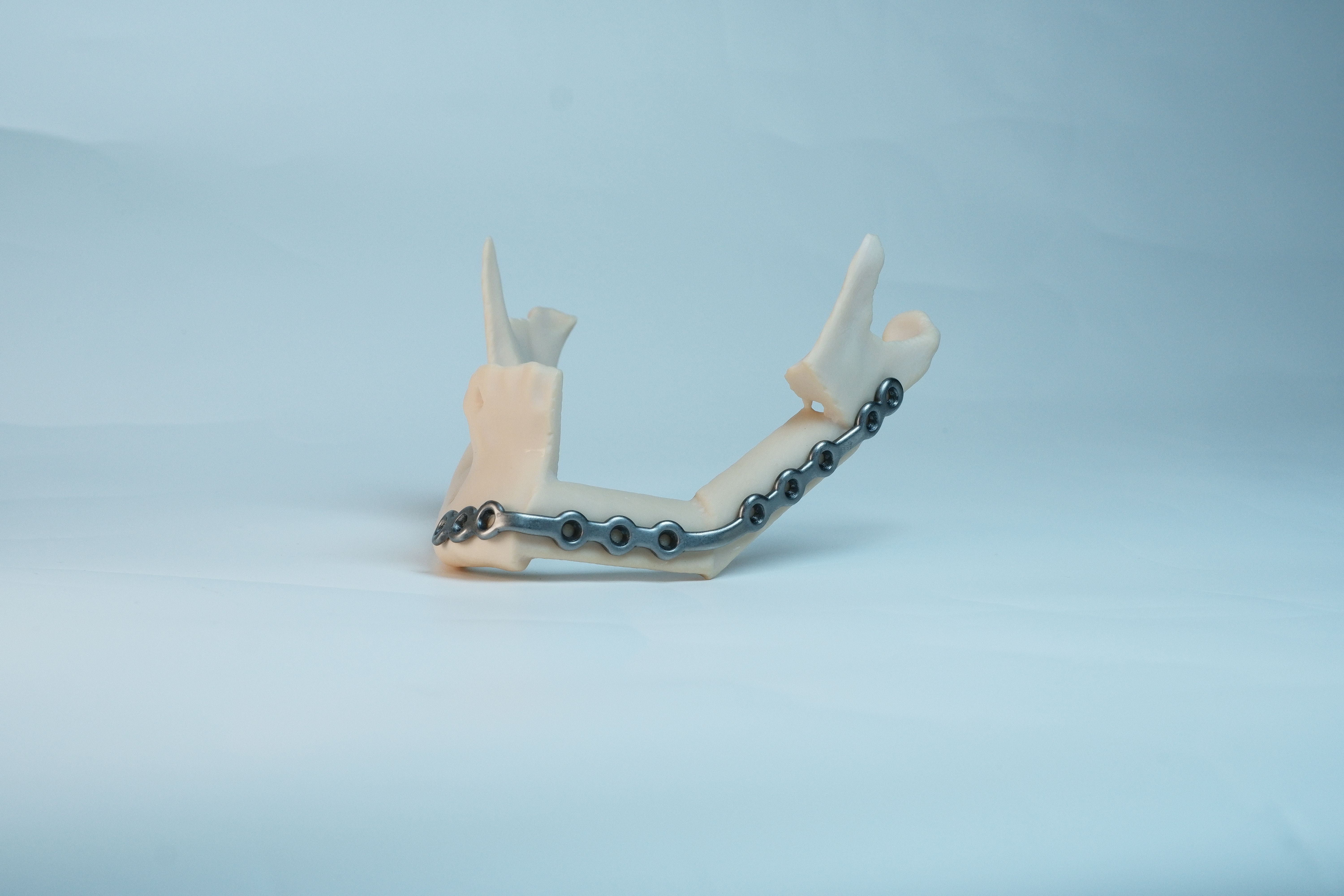 OsseoLabs: Patient-specific mandible reconstruction plate in titanium